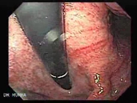 Acute Gastritis (1 of 4)