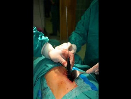 Lumbar Spondylosis - lateral access - XLIF