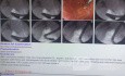 New Case for Direct Cold Forceps Biopsy From Proximal Part of CBD Cholangiocarcinoma Under Fluoroscopy