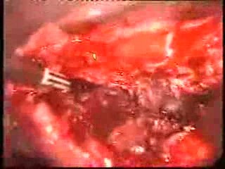 Uterine Myoma Laparoscopic Treatment