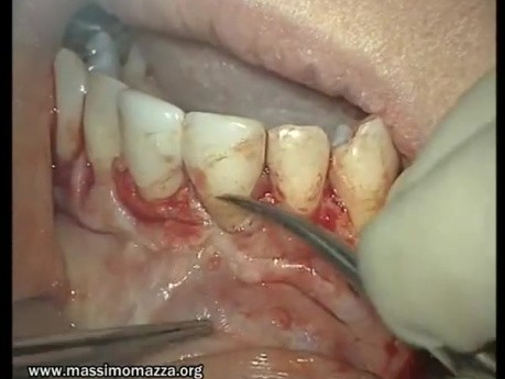 Complicated Extraction Of Tooth 11 (1/2)
