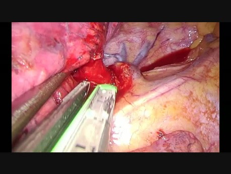 Uniportal VATS Right Upper Lobectomy