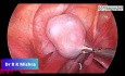Laparoscopic Oophorectomy in 3 year Old Child