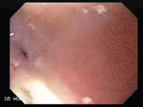 Stenosis of the esophagus caused by radiotherapy with cobalt to a carcinoma (1 of 2 )