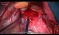 Surgery for Сarcinoma of Gastroesophageal Junction
