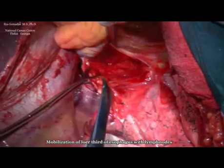 Surgery for Сarcinoma of Gastroesophageal Junction