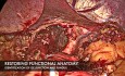 Laparoscopic Redo Fundoplication