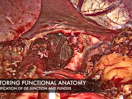 Laparoscopic Redo Fundoplication