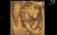 Ultrasound Image of Baby's Movement