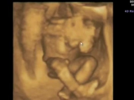 Ultrasound Image of Baby's Movement