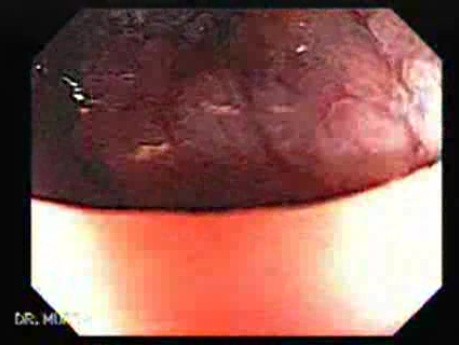 Rectal Adenocarcinoma - Colonoscopy (7 of 8)