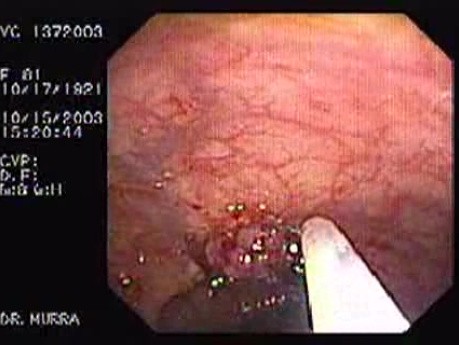 Tubulo - Villous Adenoma - Endoscopy (26 of 28)