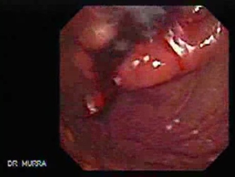 Adenocarcinoma of the Cardia and Carcinoma Epidermoid of the Larynx (15 of 26)