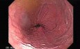 Hourglass stomach endoscopy