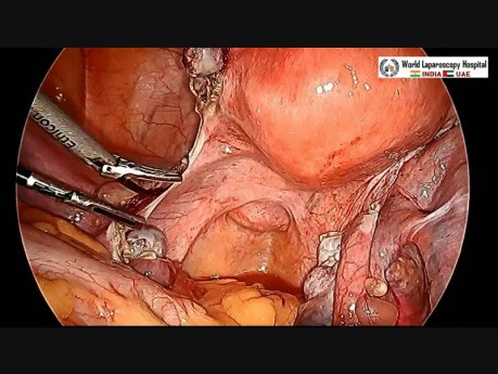 Laparoscopic Hysterectomy with Ureteral Stent Placement