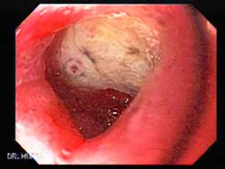 Duodenal Ulcer (2 of 4)