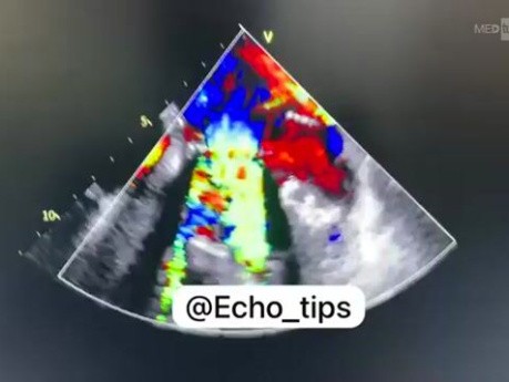 Large PVL in Mechanical Prosthetic MV