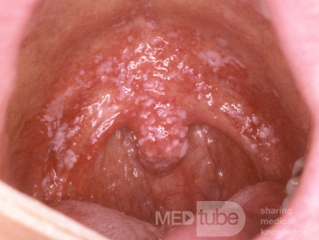 Oral Candidiasis [Thrush]