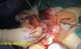 Fibroid Extraction
