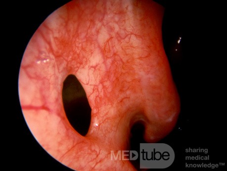 Inferior Meatal Antrostomy [right]
