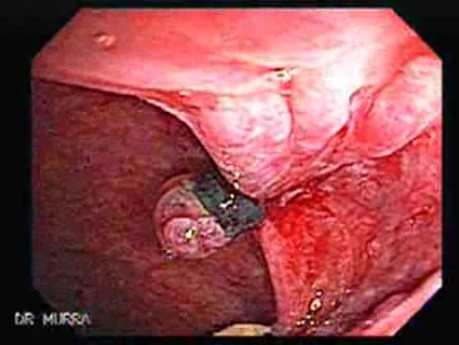 Status Post Rubber Band Ligation for Internal Hemorrhoids (7 of 7)