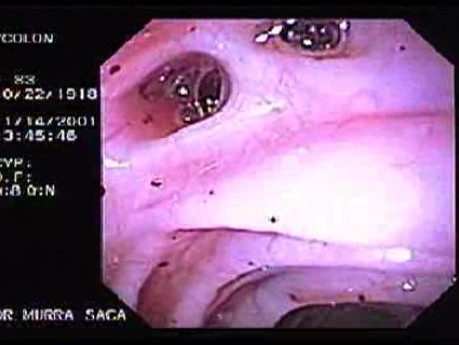 Diverticular Disease - Hemorrhage (8 of 15)