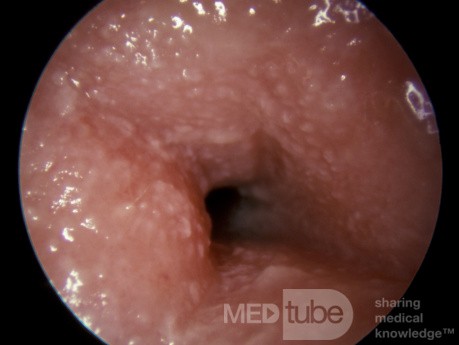 Severe Allergic Otitis Externa