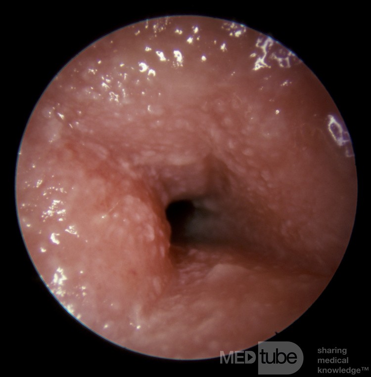 Severe Allergic Otitis Externa