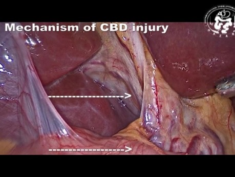 Mechanism of Common Bile Duct Injury