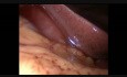 Laparoscopic Management of Chronic Ectopic Pregnancy