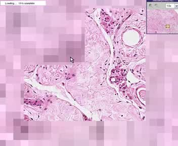 Testis - Atrophy