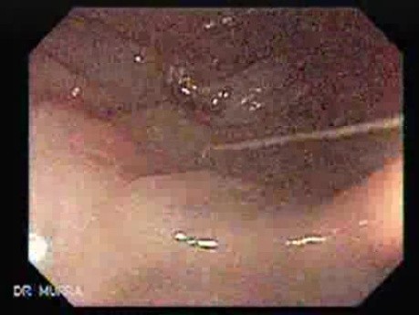 Gastrointestinal Stromal Tumour of the Rectum (1 of 3)