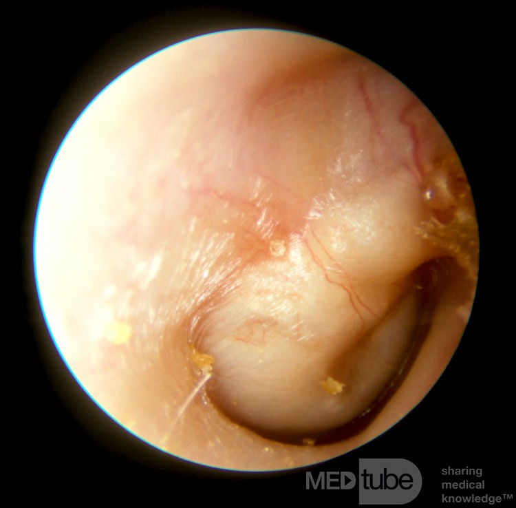 Large Congenital Cholesteatoma [epidermal cyst]