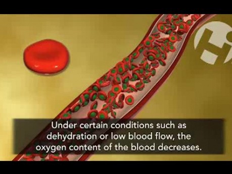 Sickle Cell Anemia Process