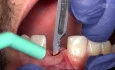 Immediate Implant Post Avulsion