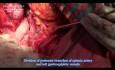 Spleen Preserving Radical Gastrectomy with D2 Lymphadenectomy