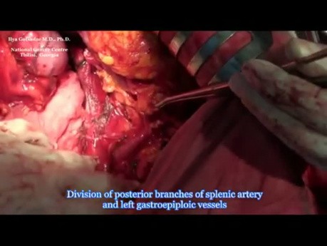 Spleen Preserving Radical Gastrectomy with D2 Lymphadenectomy