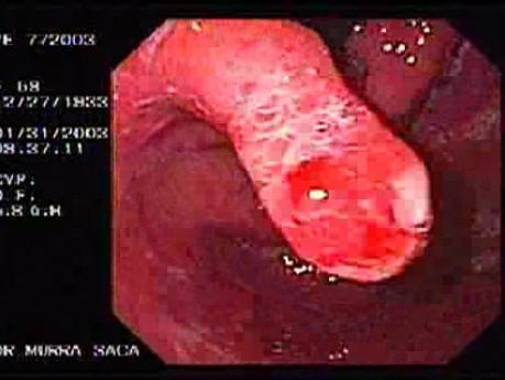 Hyperplastic Polyp - Gastric Cardia