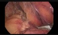 Laparoscopic Left Colectomy for Splenic Flexure Carcinoma