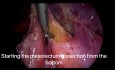 Non-oncologic Use of Peritonectomy for the Treatment of Endometriosis