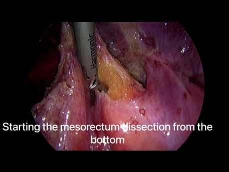 Non-oncologic Use of Peritonectomy for the Treatment of Endometriosis