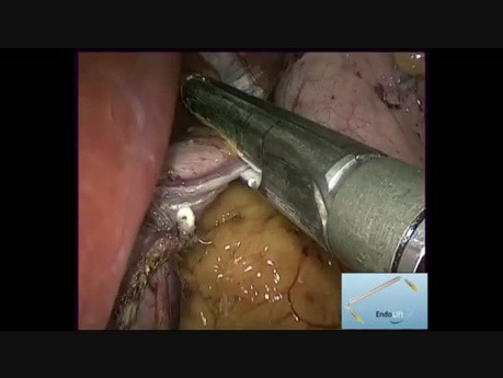 Sleeve Gastrectomy Reduced Ports with Endolift