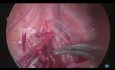 Laparoscopic Varicocelectomy