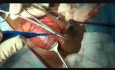 Total Thyroidectomy for Multinodular Goitre