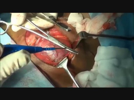 Total Thyroidectomy for Multinodular Goitre