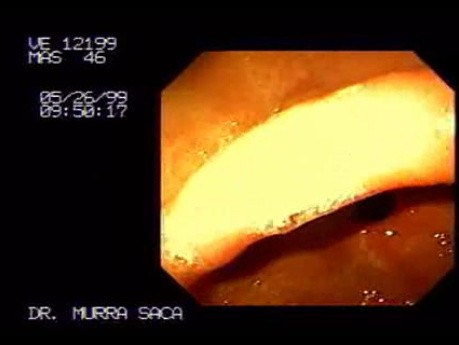Normal Stomach in Endoscopy