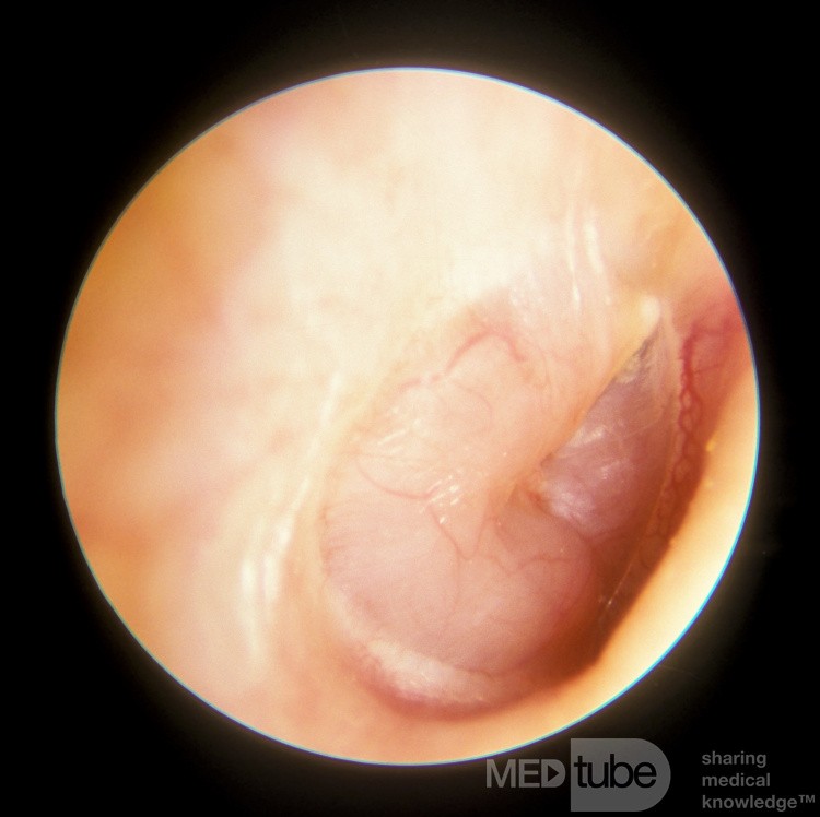 Acoustic Neuroma Middle Ear