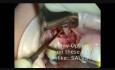 Sinus Grafting for Dental Implants