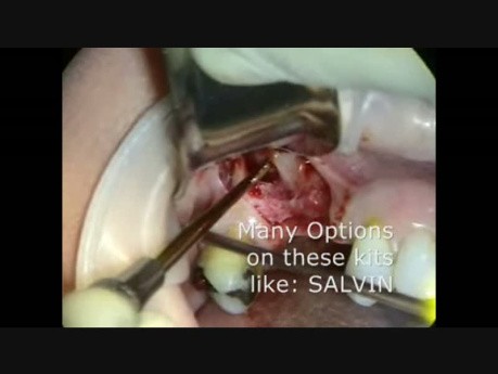 Sinus Grafting for Dental Implants