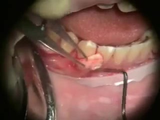 Periodontal Grafting - Microsurgery